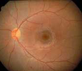 Leber Congenital Amaurosis